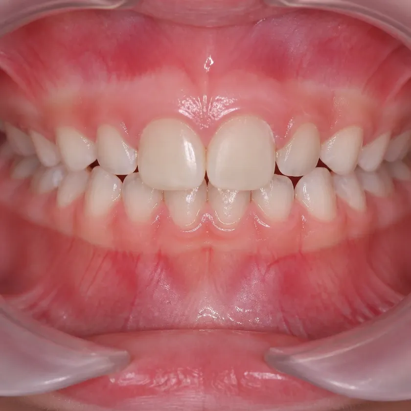 pediatric dental prosthetics — close-up clinical photo of the result after treatment