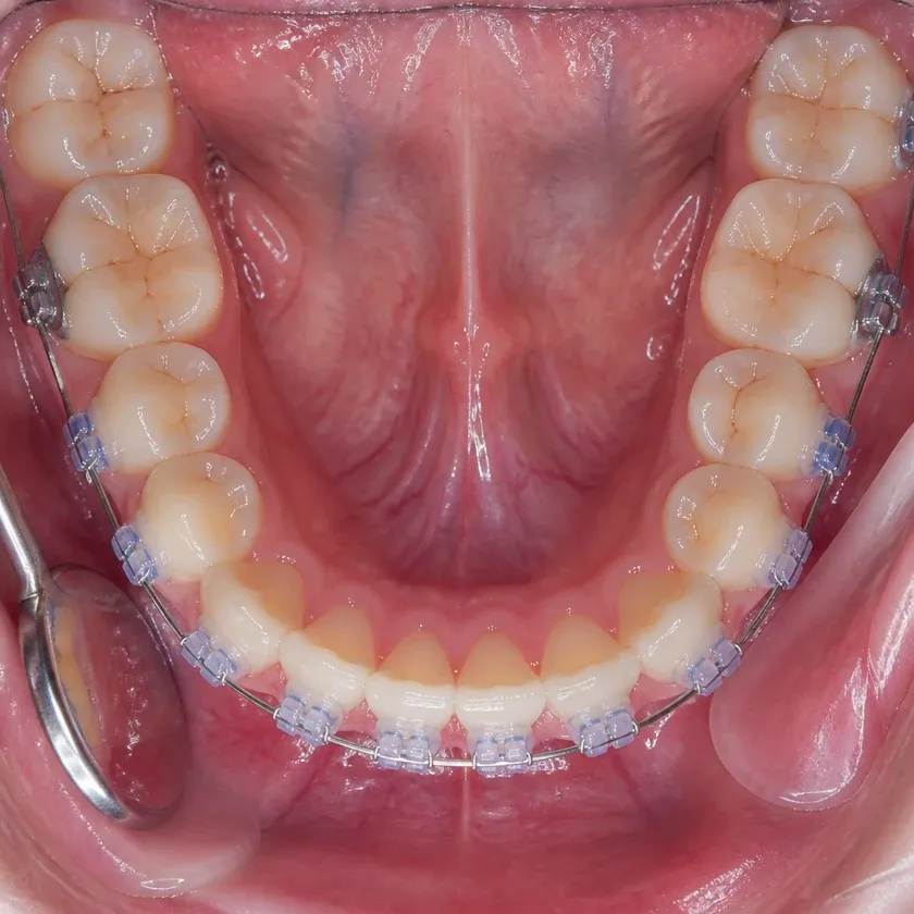 Sapphire braces — close-up clinical photo of the result after treatment