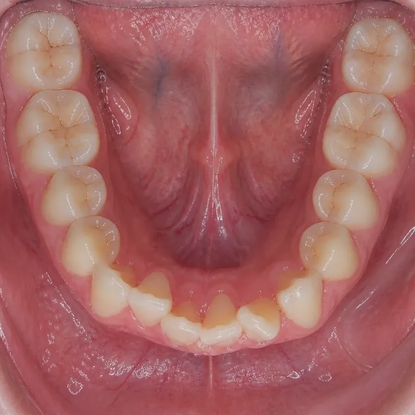 Sapphire braces — before treatment, clinical photograph