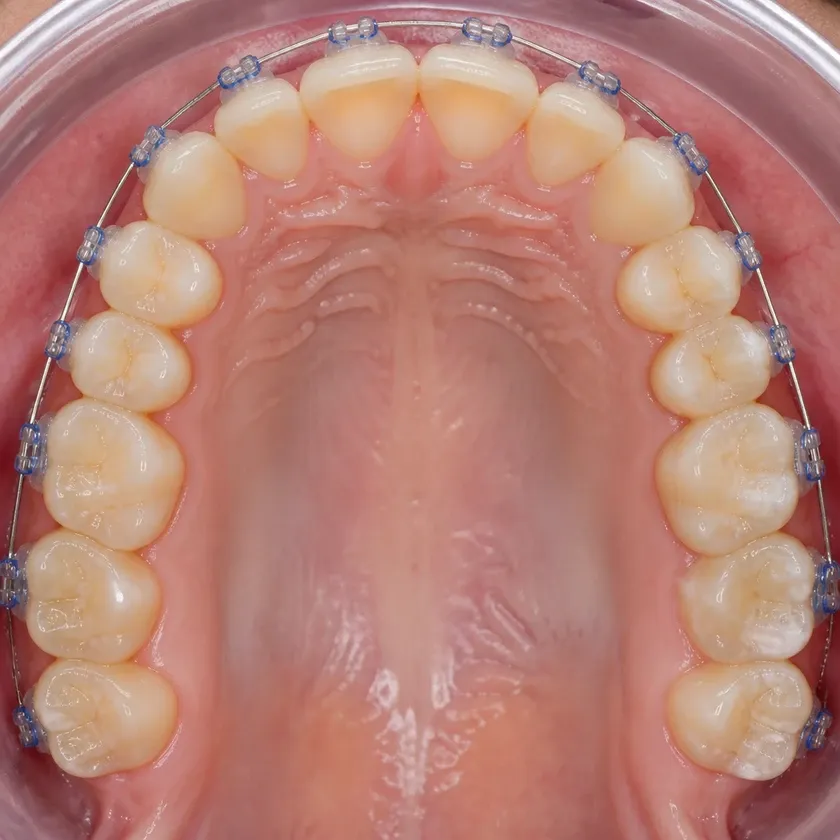Sapphire braces — close-up clinical photo of the result after treatment