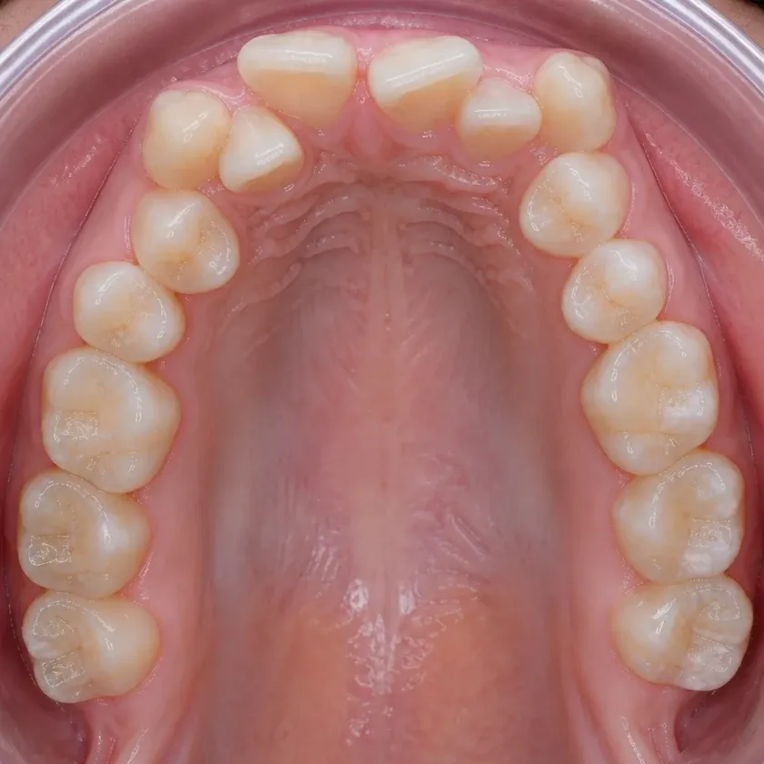 Sapphire braces — before treatment, clinical photograph