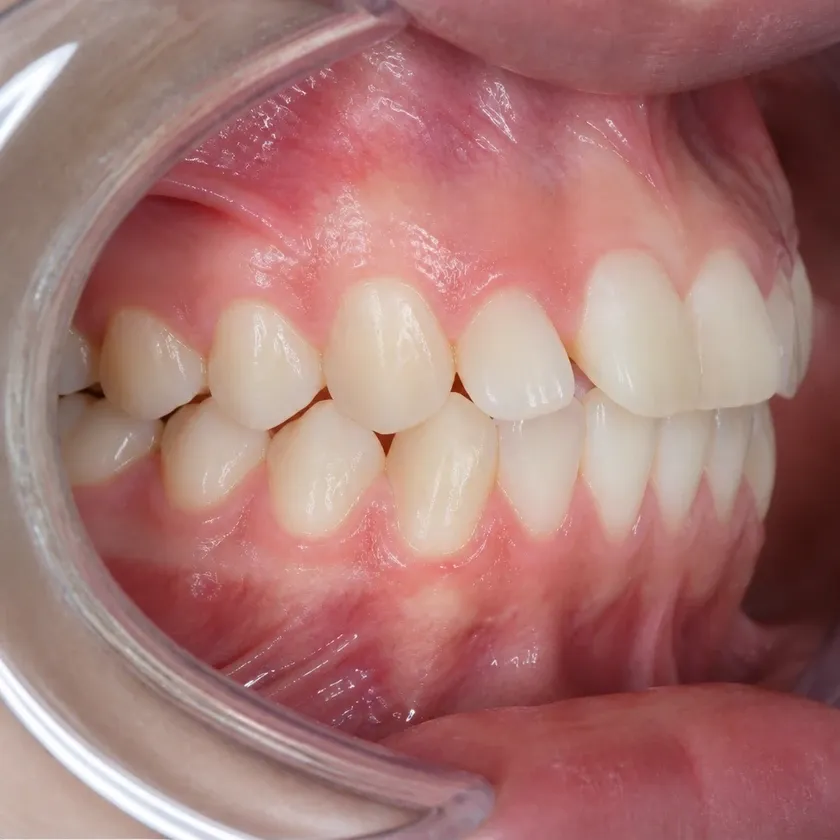 Sapphire braces — before treatment, clinical photograph
