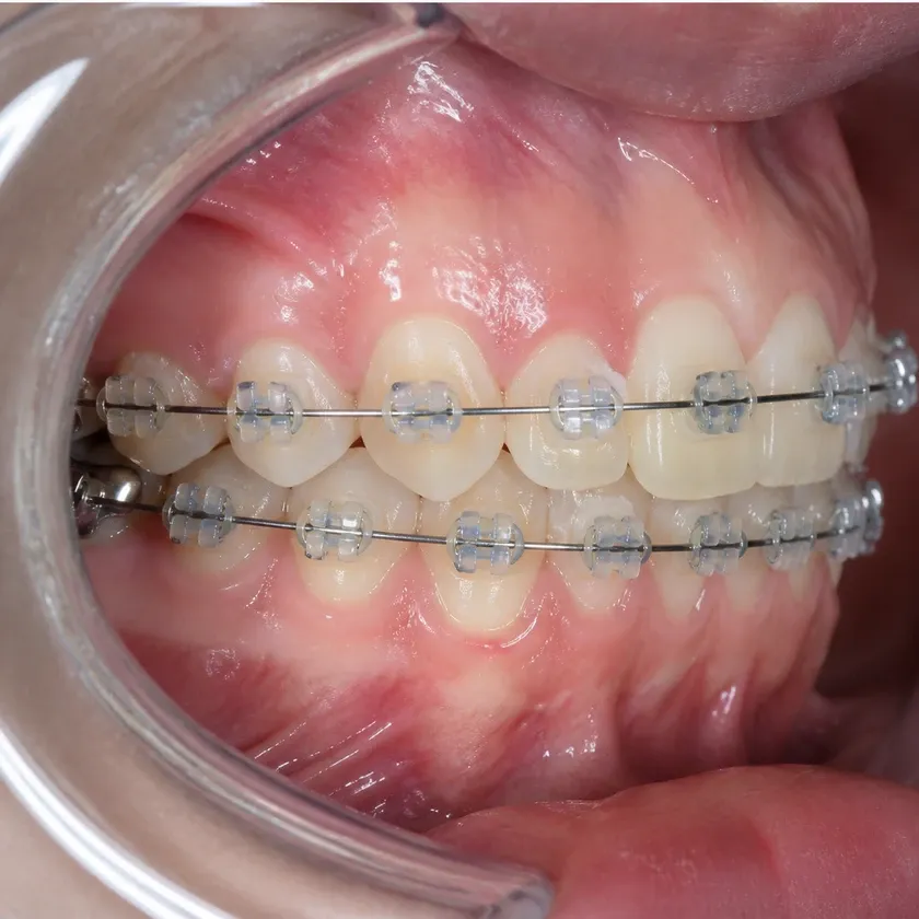 Sapphire braces — close-up clinical photo of the treatment result