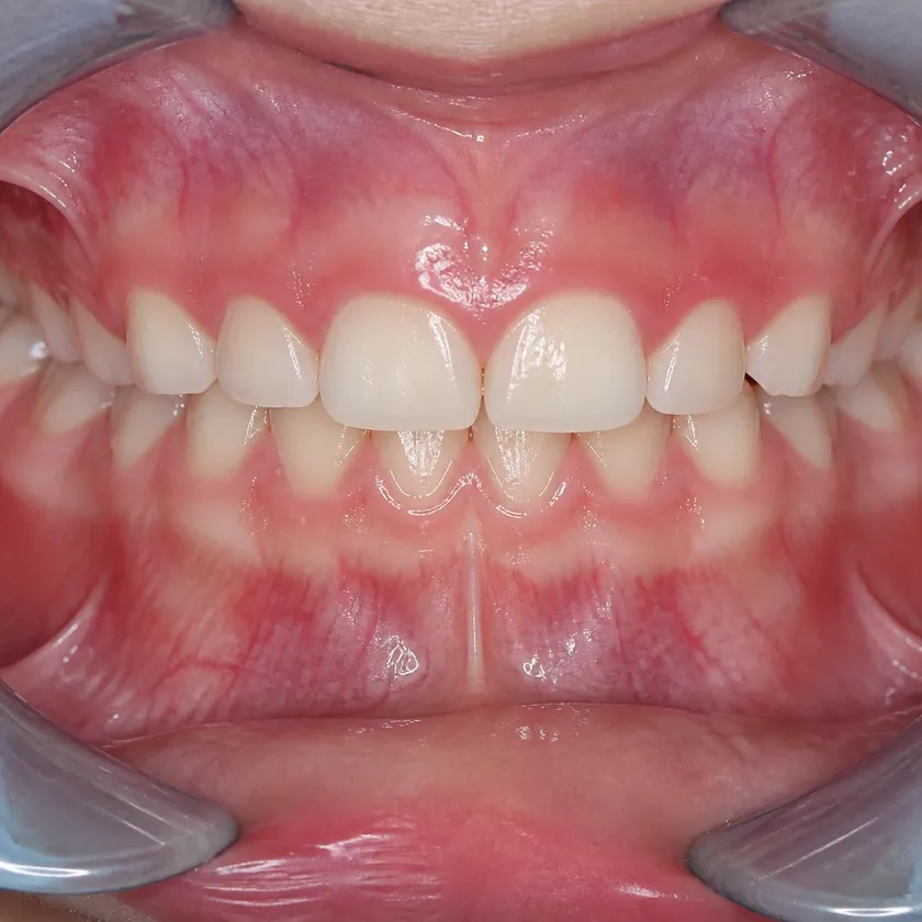 sedation for children — close-up result after treatment in a clinical photo