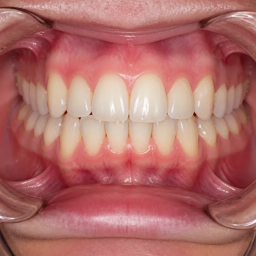 multi-loop archwire technique — close-up of the result after treatment in a clinical photograph
