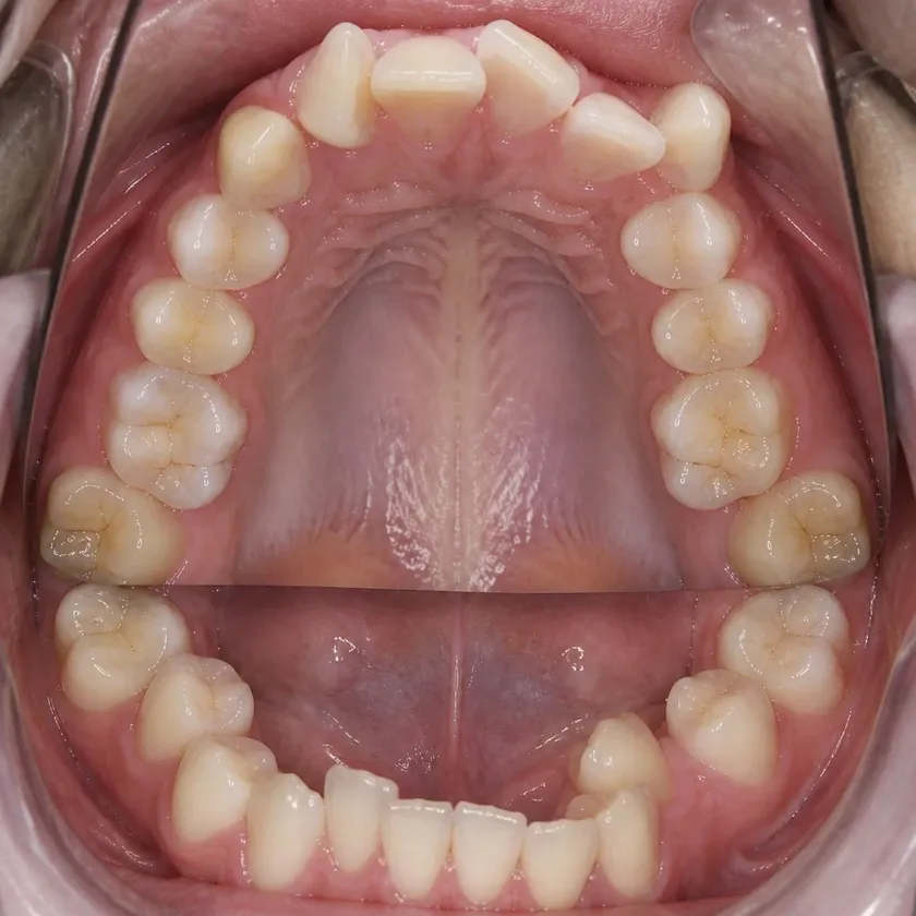 Vestibular multiloop edgewise archwire (MEAW) technique — pre-treatment clinical photograph