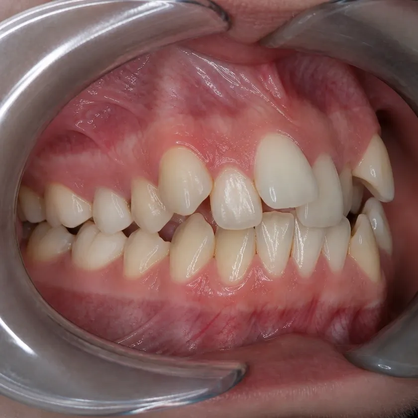 Vestibular multiloop edgewise archwire (MEAW) technique — pre-treatment clinical photograph