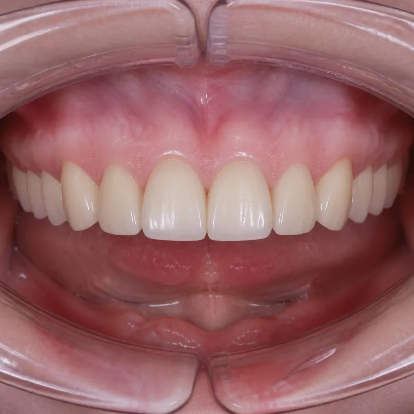 Titanium dental implants — close-up of the result after treatment in a clinical photograph