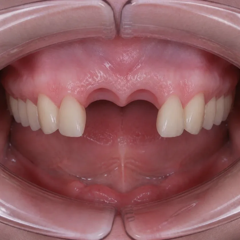 Titanium dental implants — pre-treatment condition on a clinical image