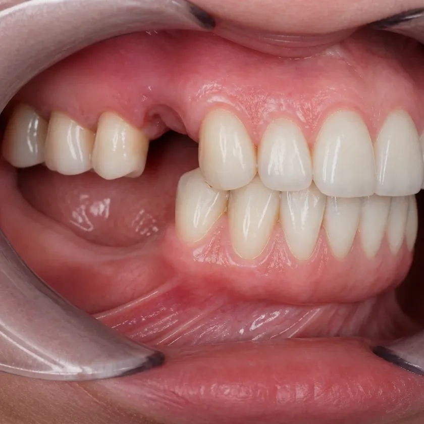 Titanium dental implants — pre-treatment condition on a clinical image