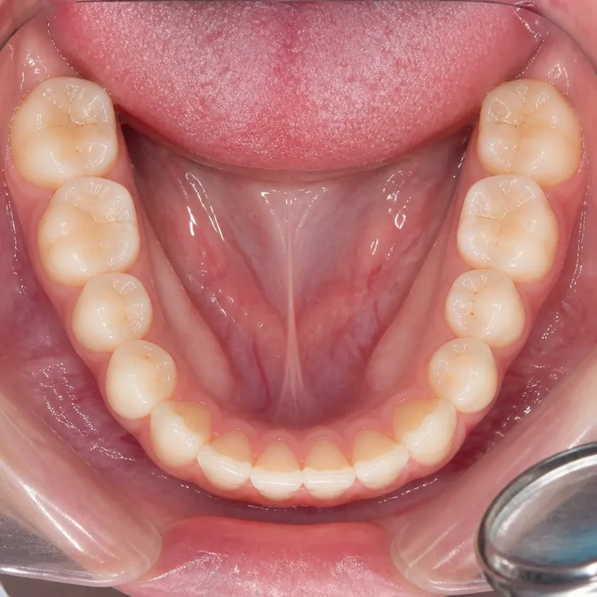 Dental aligners — close-up clinical photo of the result after treatment