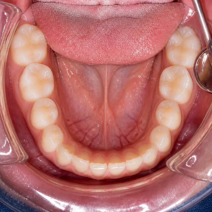 Dental trainers for children — close-up clinical photo of the result after treatment