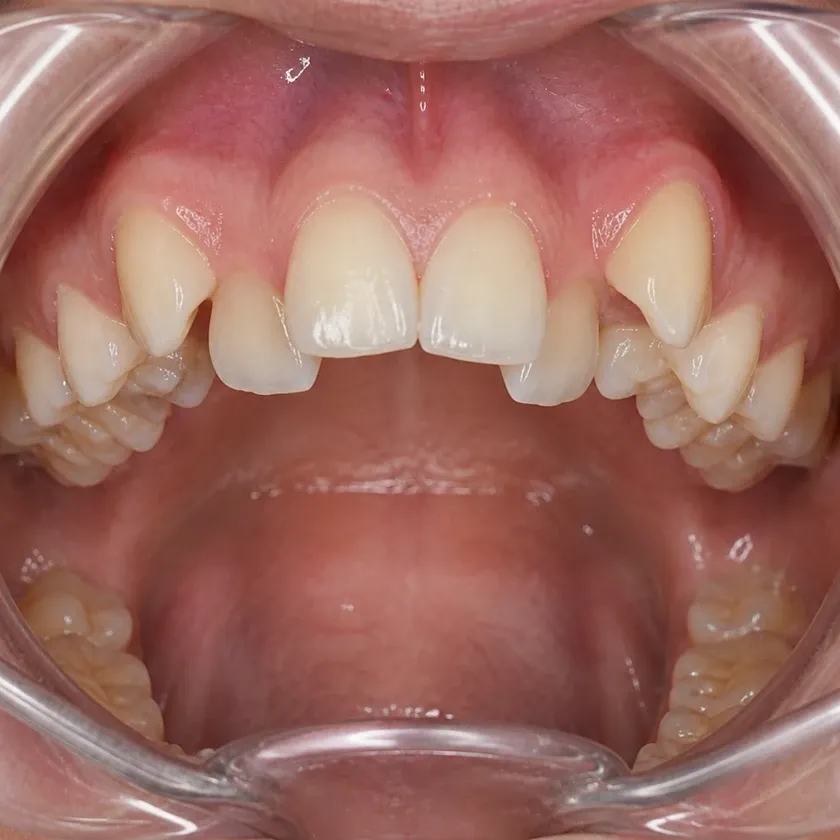 Kids' dental trainers — pre-treatment condition in a clinical photograph