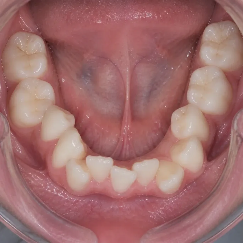 Kids' dental trainers — pre-treatment condition in a clinical photograph
