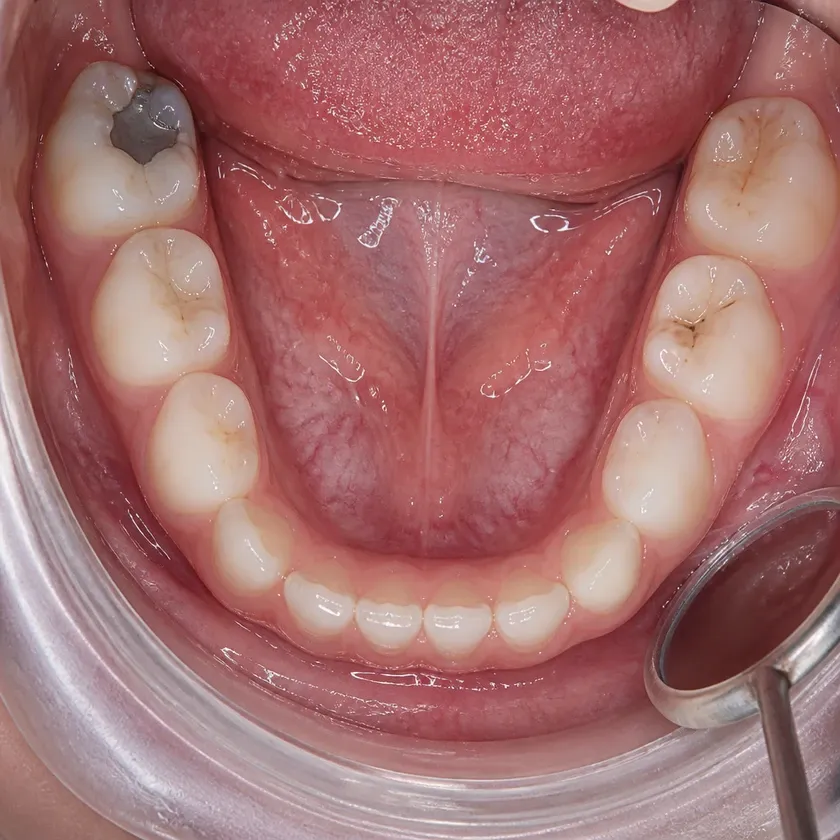 Primary tooth pulp removal — close-up clinical image of the result after treatment