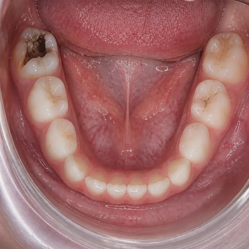 Pulpectomy of a primary tooth — pre-treatment condition on a clinical image