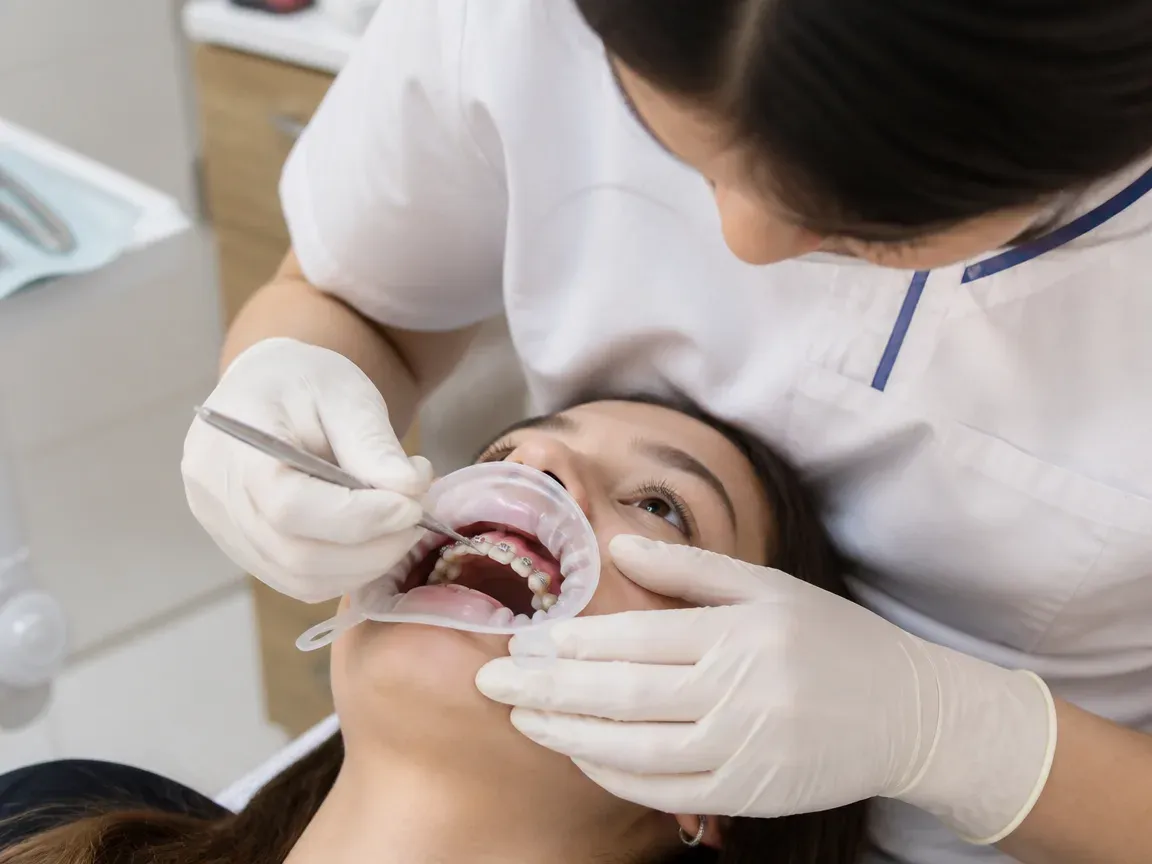 The treatment stage itself: the doctor's gloved hands working inside the oral cavity — an illustration for the "Bracket Bonding" section
