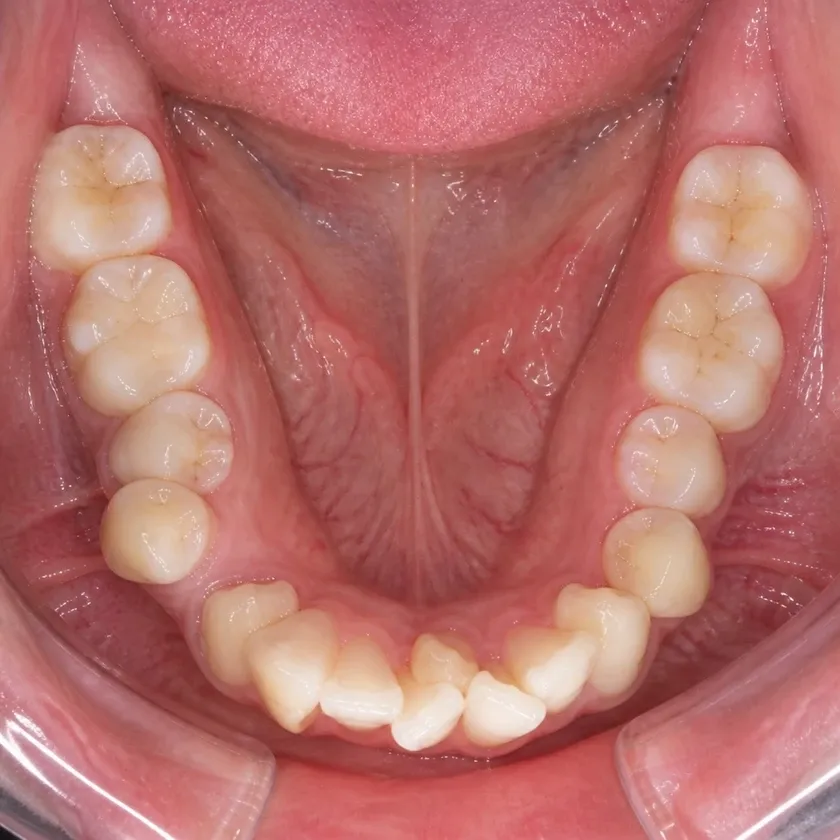 Vestibular multiloop edgewise archwire (MEAW) technique — pre-treatment clinical photograph