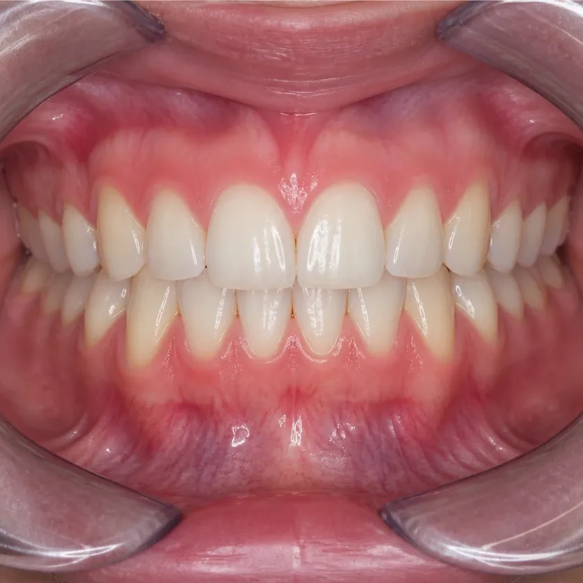 Vestibular MEAW (Multiloop Edgewise Archwire) technique — close-up clinical photograph showing the result after treatment