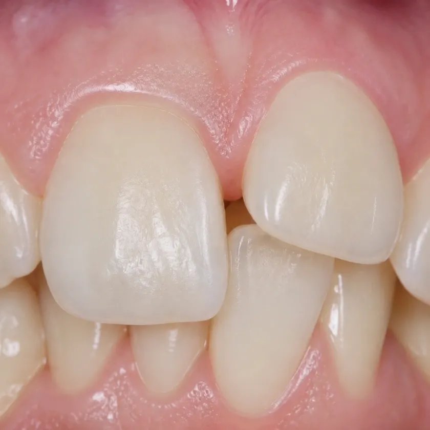 Vestibular multiloop edgewise archwire (MEAW) technique — pre-treatment clinical photograph