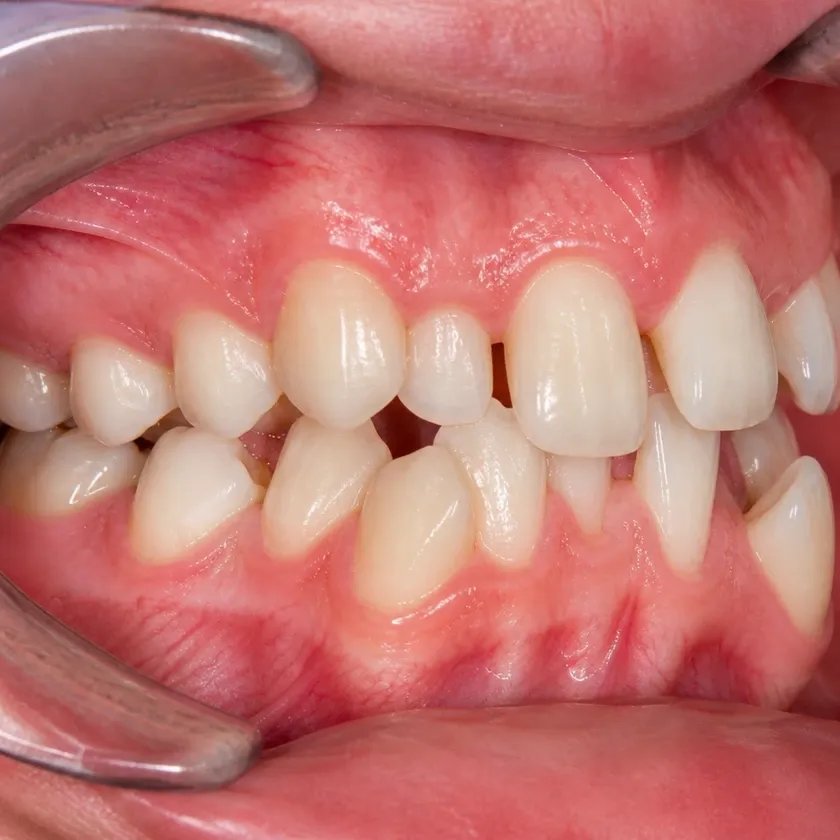 Vestibular multiloop edgewise archwire (MEAW) technique — pre-treatment clinical photograph