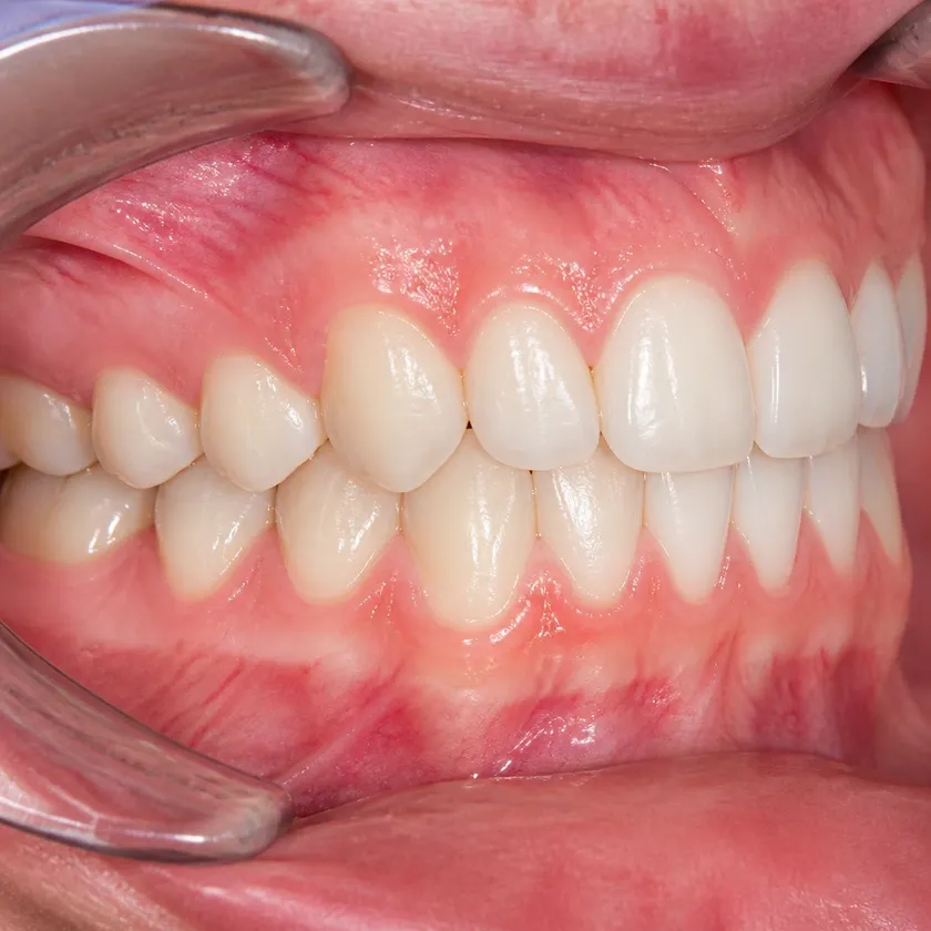 Vestibular multiloop edgewise archwire (MEAW) technique — close-up clinical photograph of the result after treatment