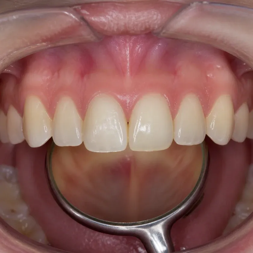 internal bleaching — close-up result after treatment on a clinical image