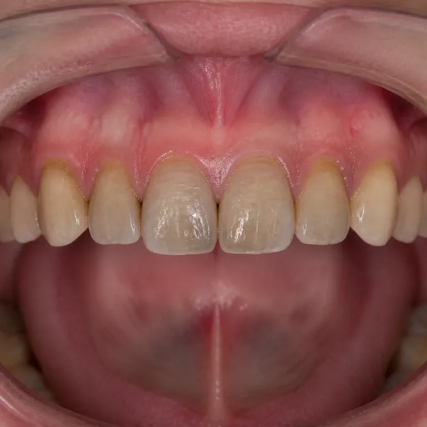 intracoronal bleaching — before-treatment condition on the clinical image
