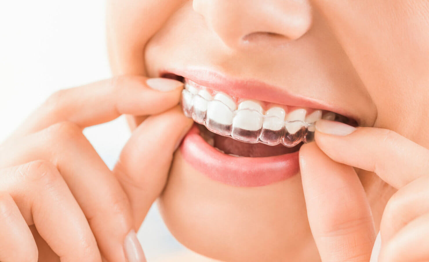 1️⃣ Элайнеры Алматы | Клиника «Dental Center»