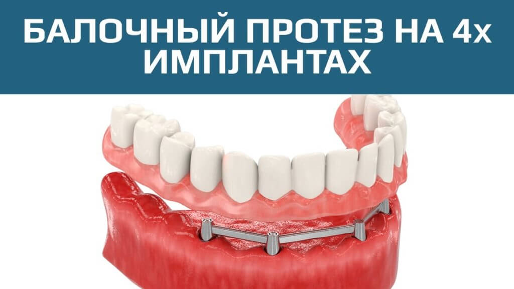 протезирование зубов на 4 имплантах стоимость Алматы