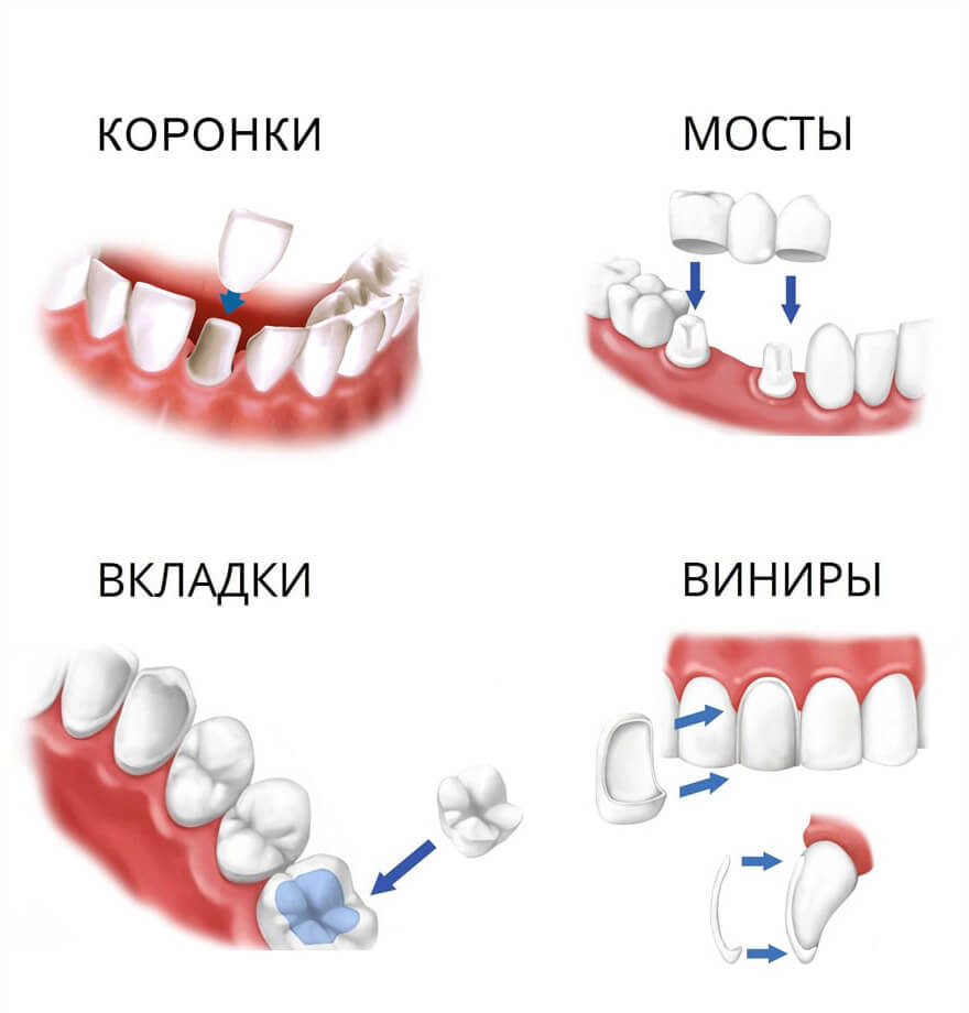 протезирование зубов в Алматы