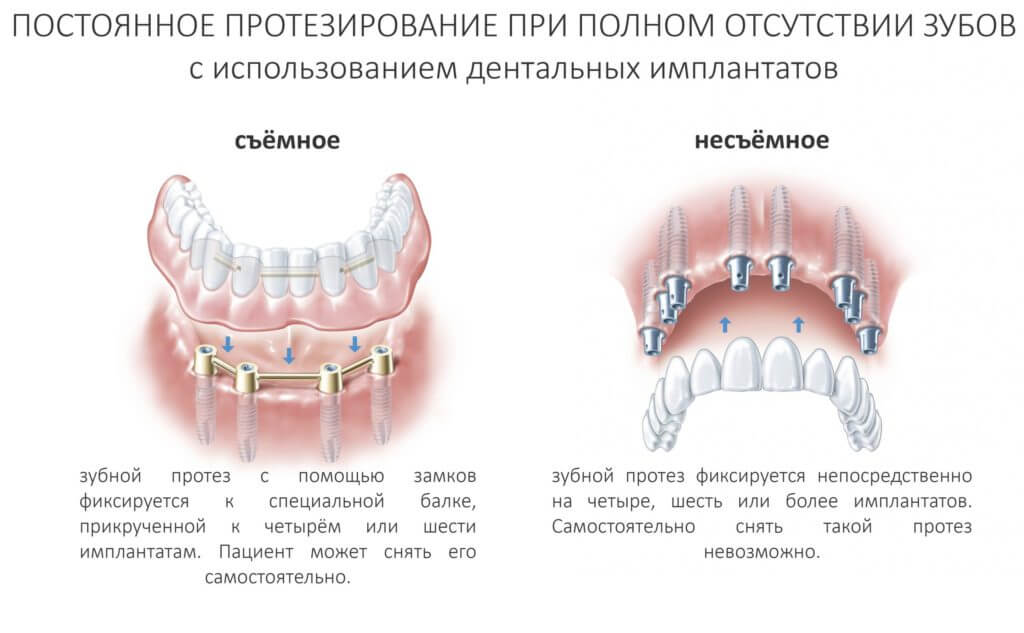 Виды протезирования при отсутствии нескольких зубов