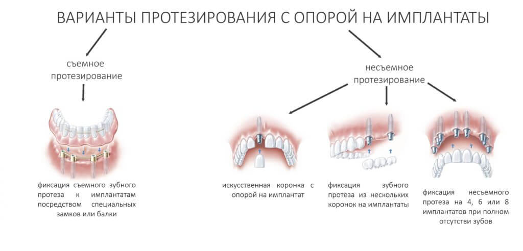 Виды протезирования при отсутствии нескольких зубов